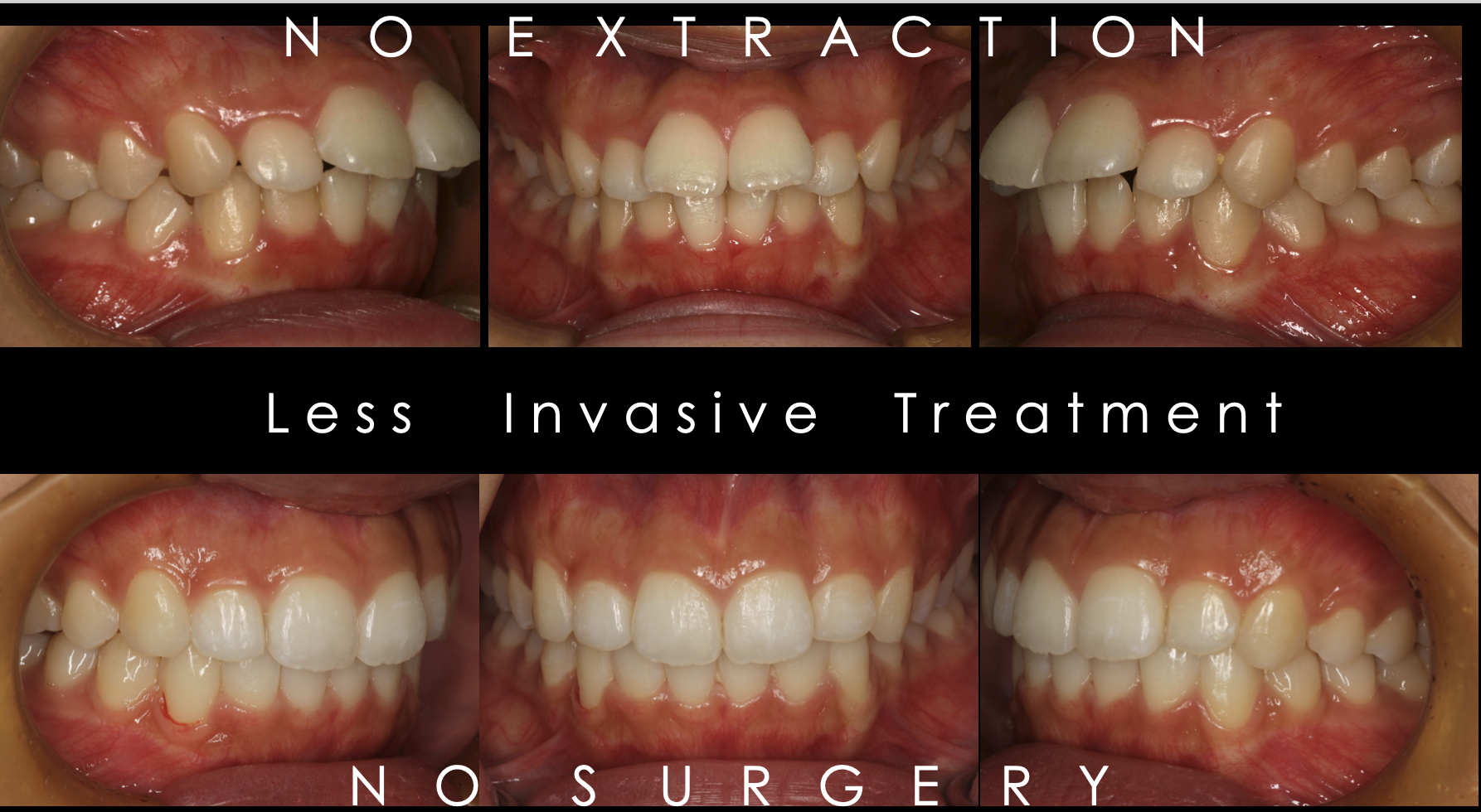 インビザライン（マウスピース矯正治療）で非抜歯矯正を目指すための3つの方法