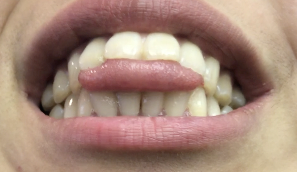 歯を抜かない矯正治療は「舌癖改善」も重要です