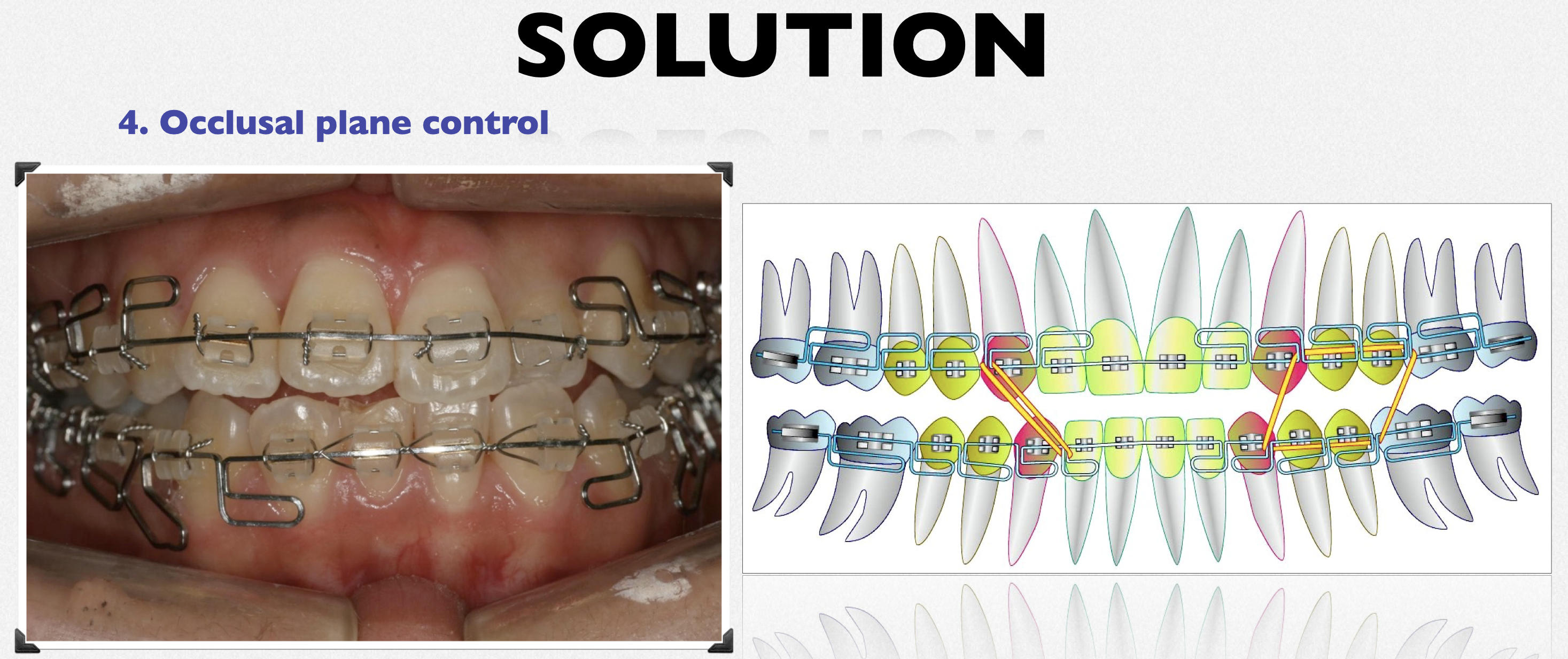 MEAW（マルチループワイヤー）使用した　歯を抜かない矯正