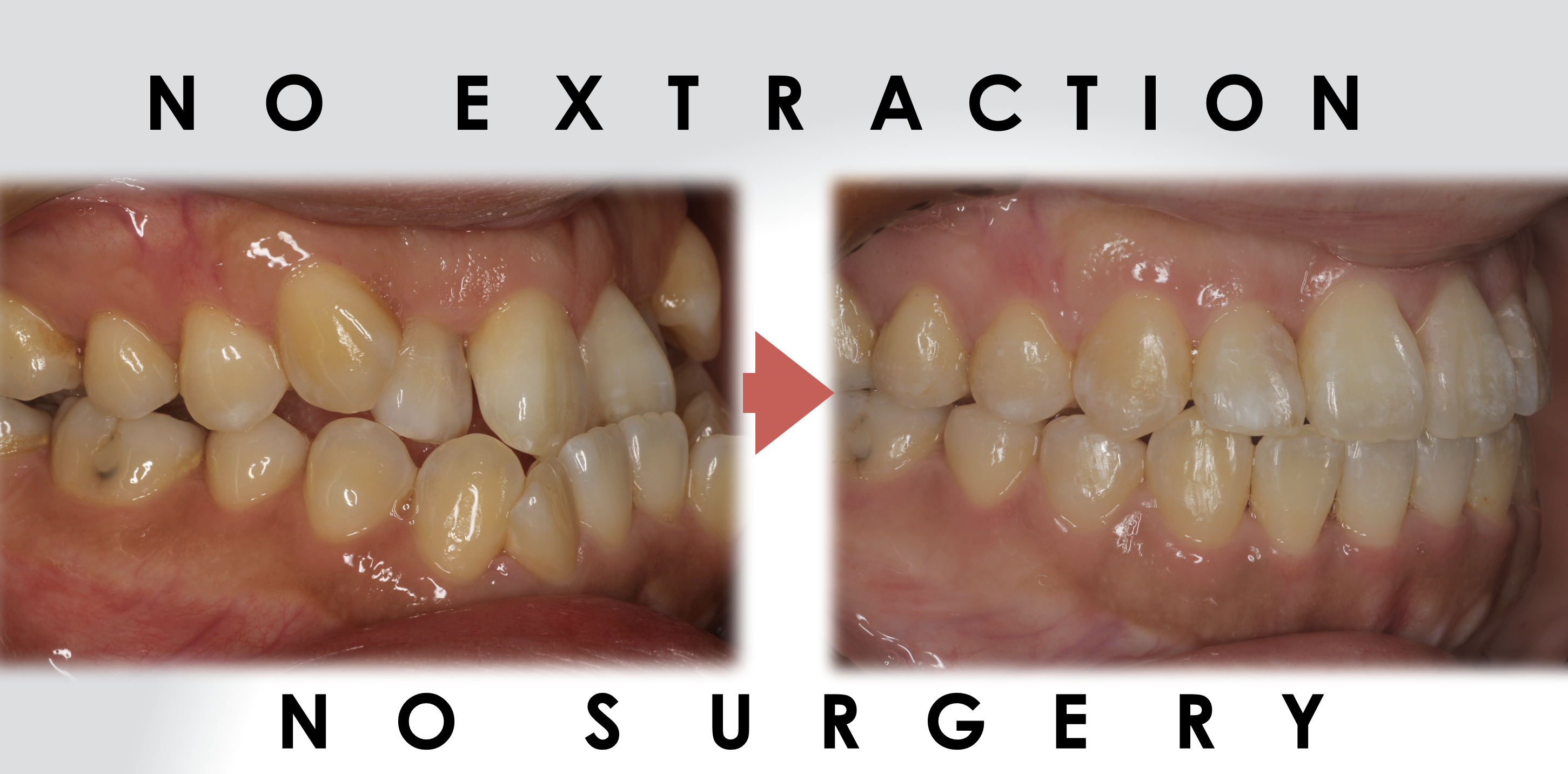 他院で「手術が必要」と言われた方へ  ～当院が“手術なし矯正”を提案できる理由（MEAW＋TAD）～
