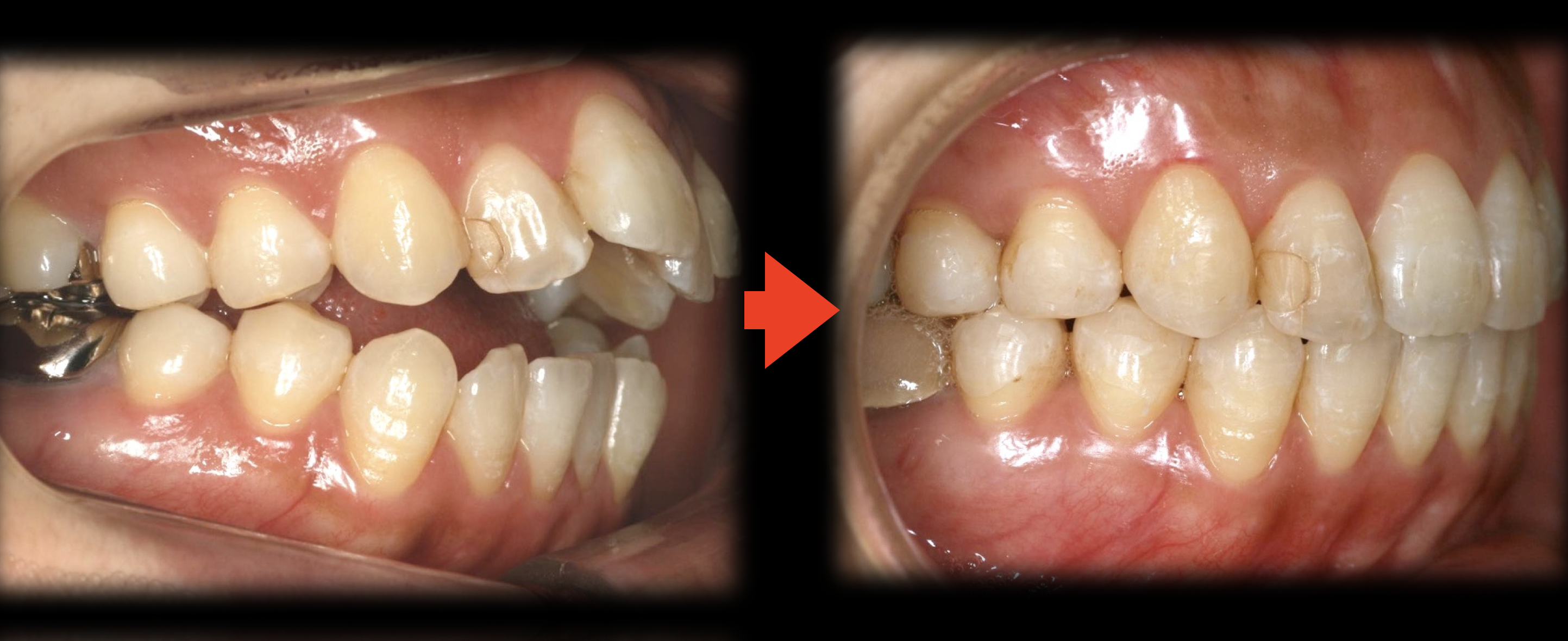手術しない矯正治療　非外科矯正治療
