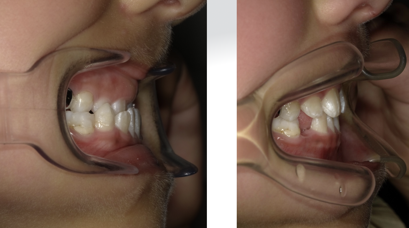 お子様の矯正治療　拡大床