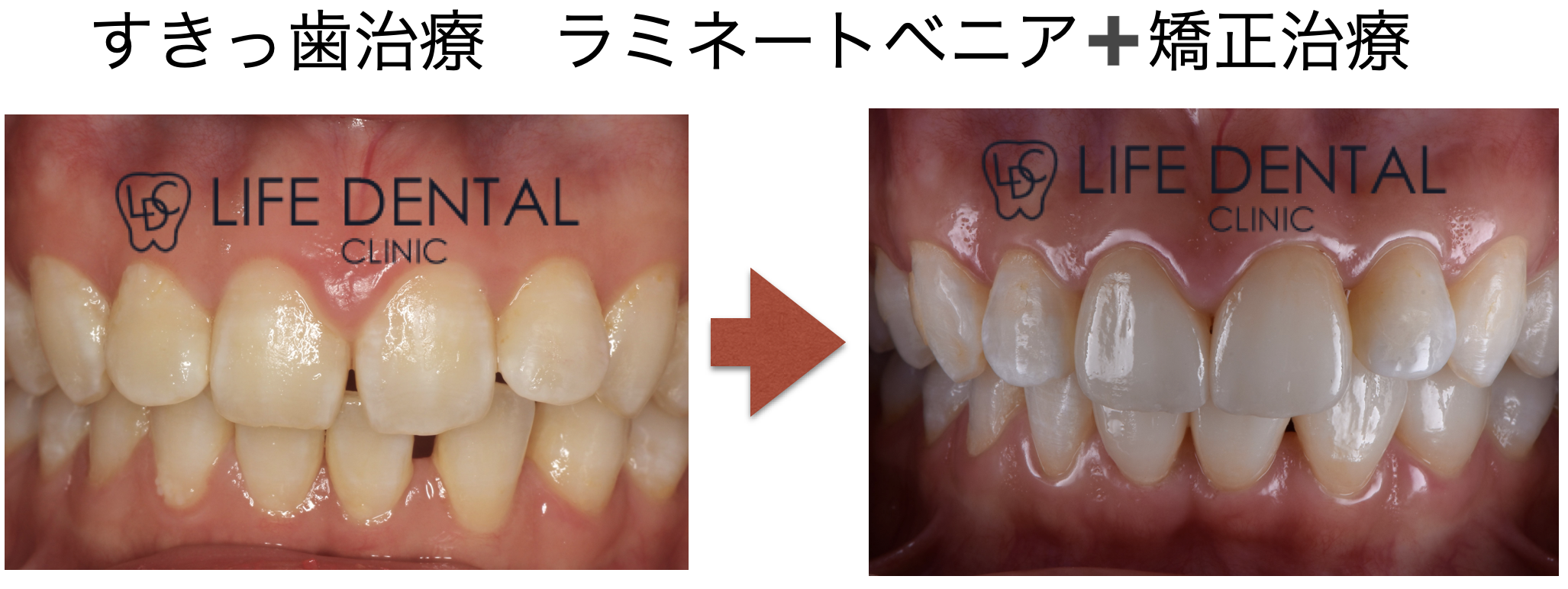すきっ歯（空隙歯列・正中離開）の治療法とは？