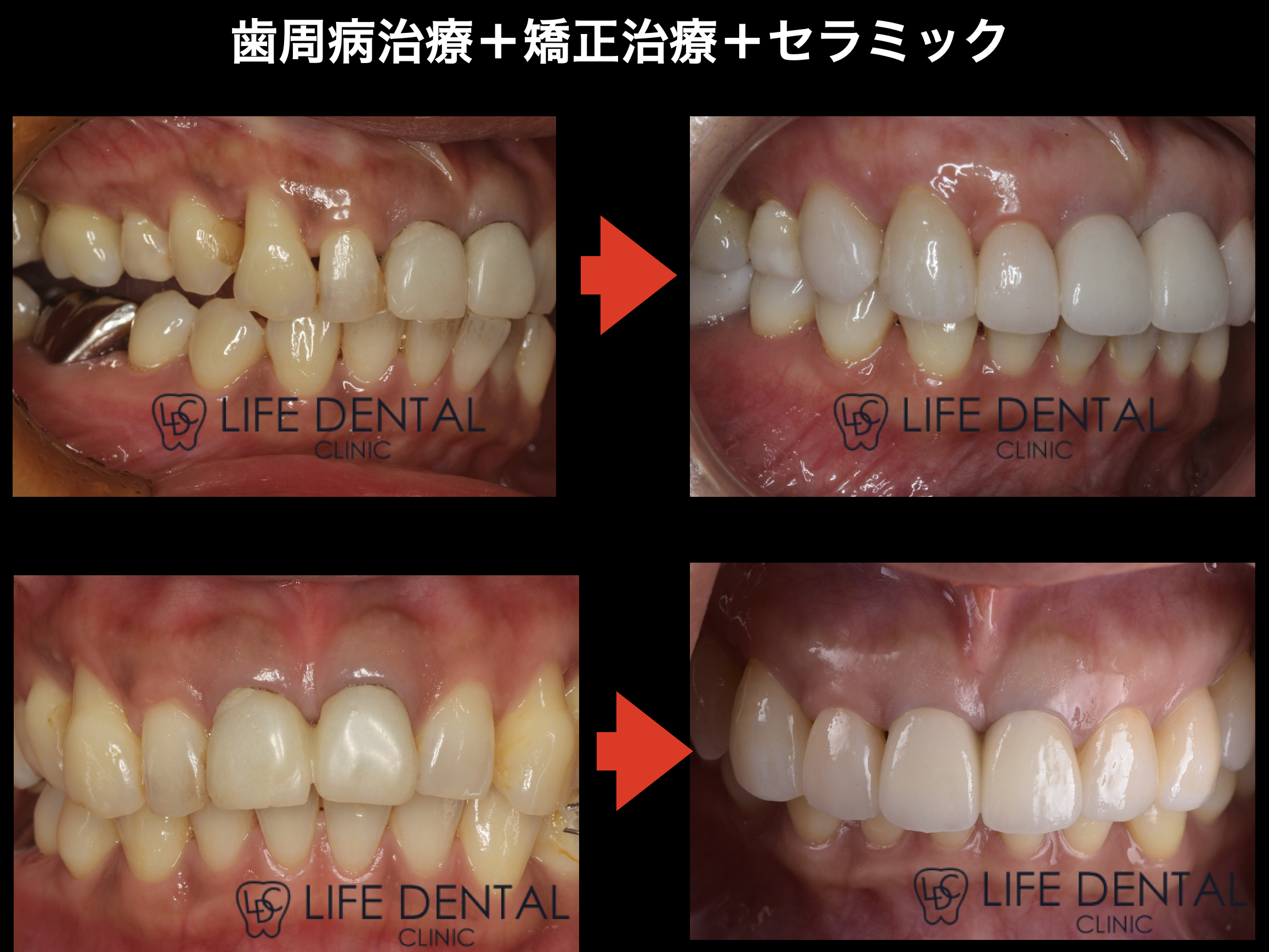 歯周病があっても矯正治療はできる？