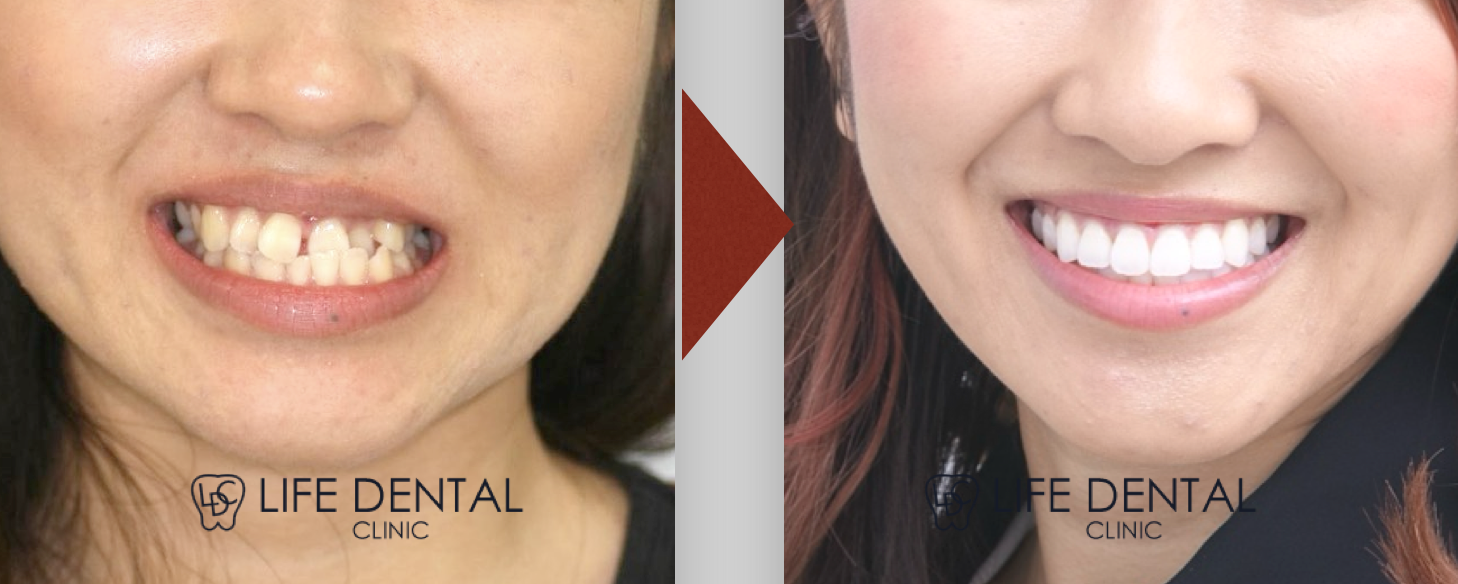 顔の歪みは矯正治療でどこまで改善できる？