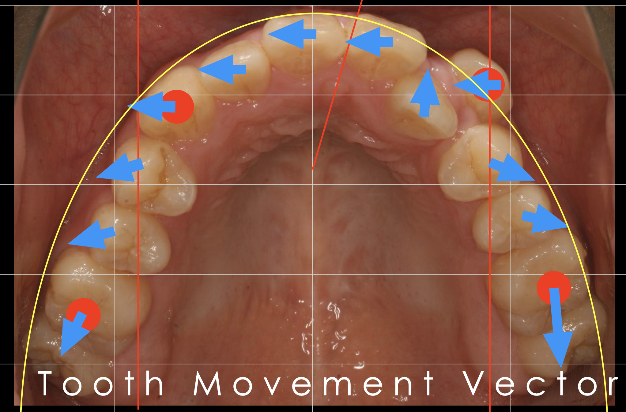 歯を抜かない矯正治療を実現するために大切なこと