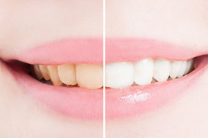 口元の印象を作る「色」の効果ホワイトニングで歯を白く